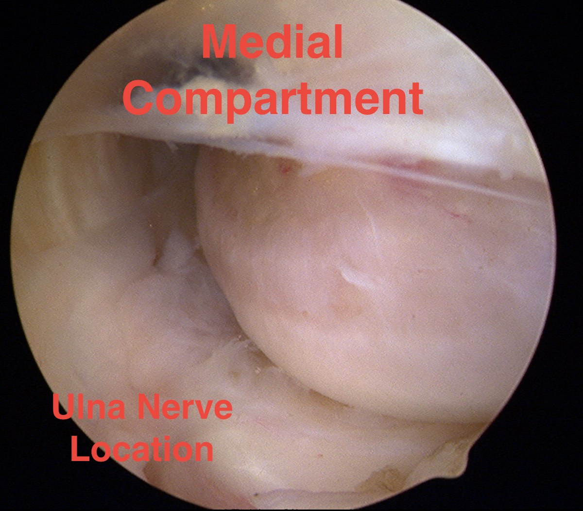 Elbow Arthroscopy Medial Compartment